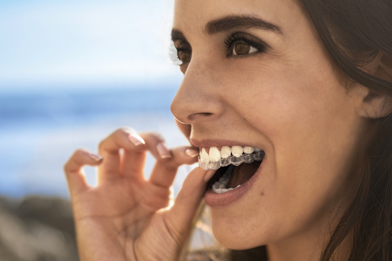 invisalign indossato