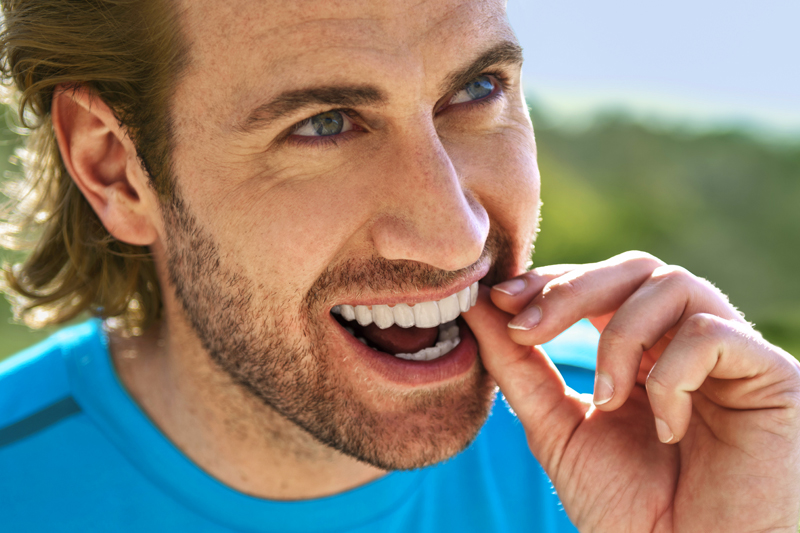 mascherina invisalign indossata